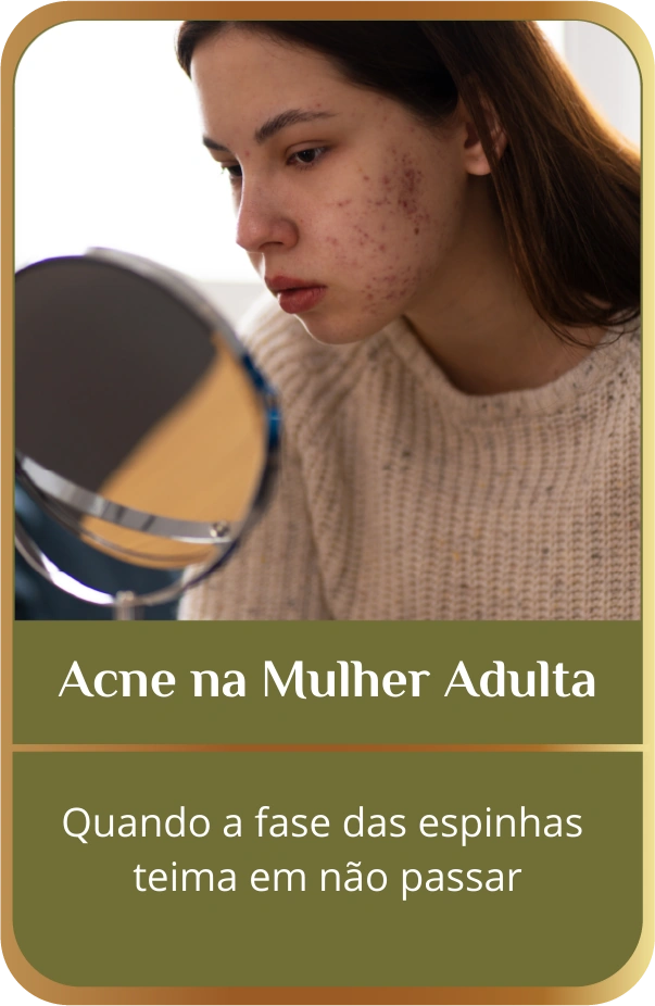 acne na mulher adulta. quando a fase das espinhas teima em não passar