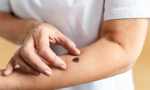 high-angle-hand-measuring-mole-scaled
