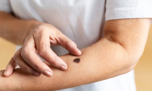 high-angle-hand-measuring-mole