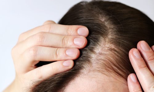 Initial stage of baldness, close-up. Young woman showing bald spots on forehead and temples. Hair loss, alopecia. Concept of hair problems and their treatment. Hair care. Close-up of bald spots