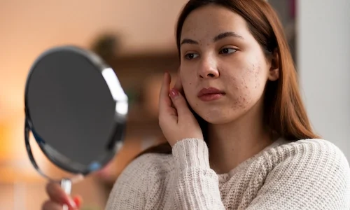 person-dealing-with-rosacea-scaled