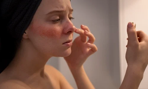 woman-looking-her-rosacea-mirror-scaled