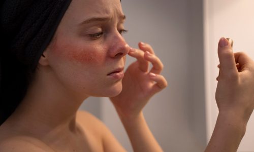 woman-looking-her-rosacea-mirror